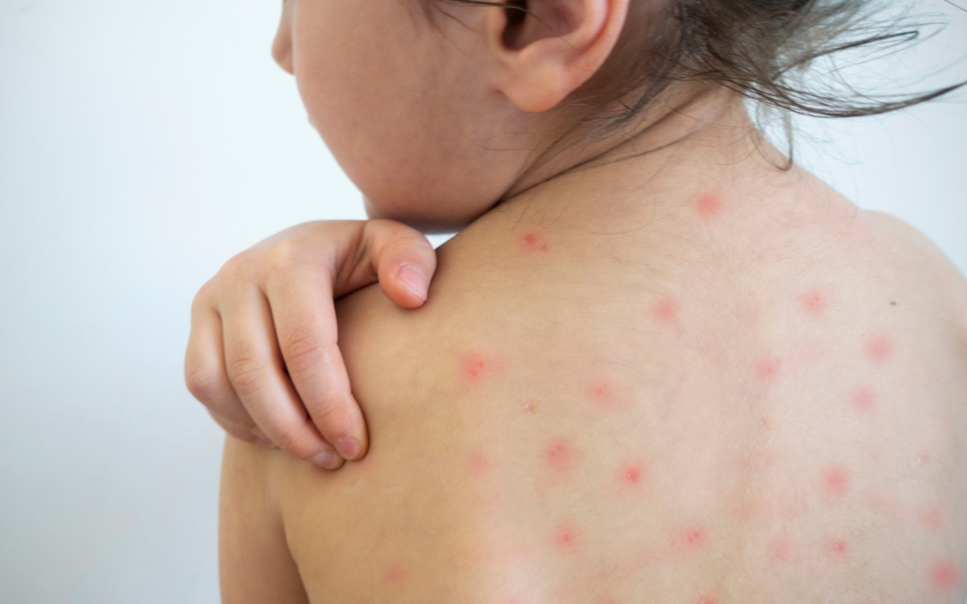 Refuerzan la prevención de cuadros de Varicela en establecimientos educacionales