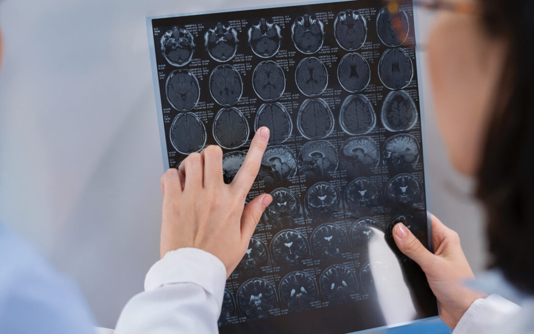 Enfermedades del cerebro: ¿cuáles son las más comunes en Chile?